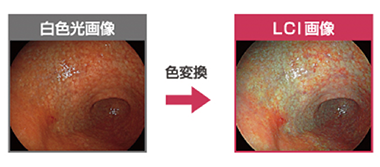 実際の内視鏡検査(LCI画像)の写真がこちらです。